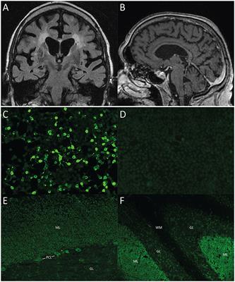 Anti-ARHGAP26 Autoantibodies Are Associated With Isolated Cognitive Impairment